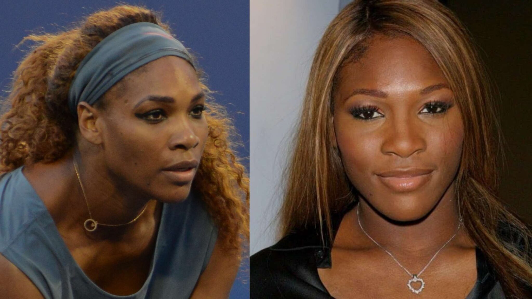 Serena Williams Plastic SurgeryBefore And After 2024 The Healthstore